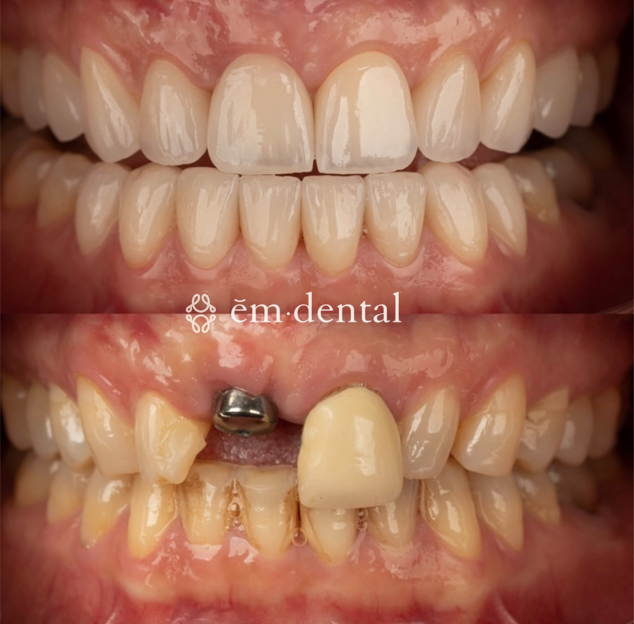 Porcelain veneers treatment in London