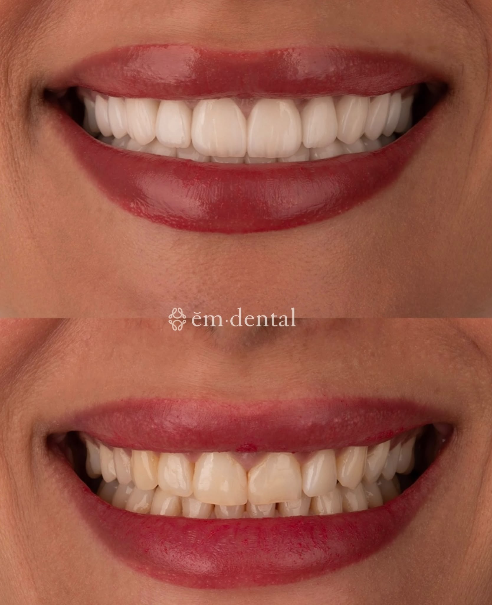 Porcelain veneers London at ēm dental