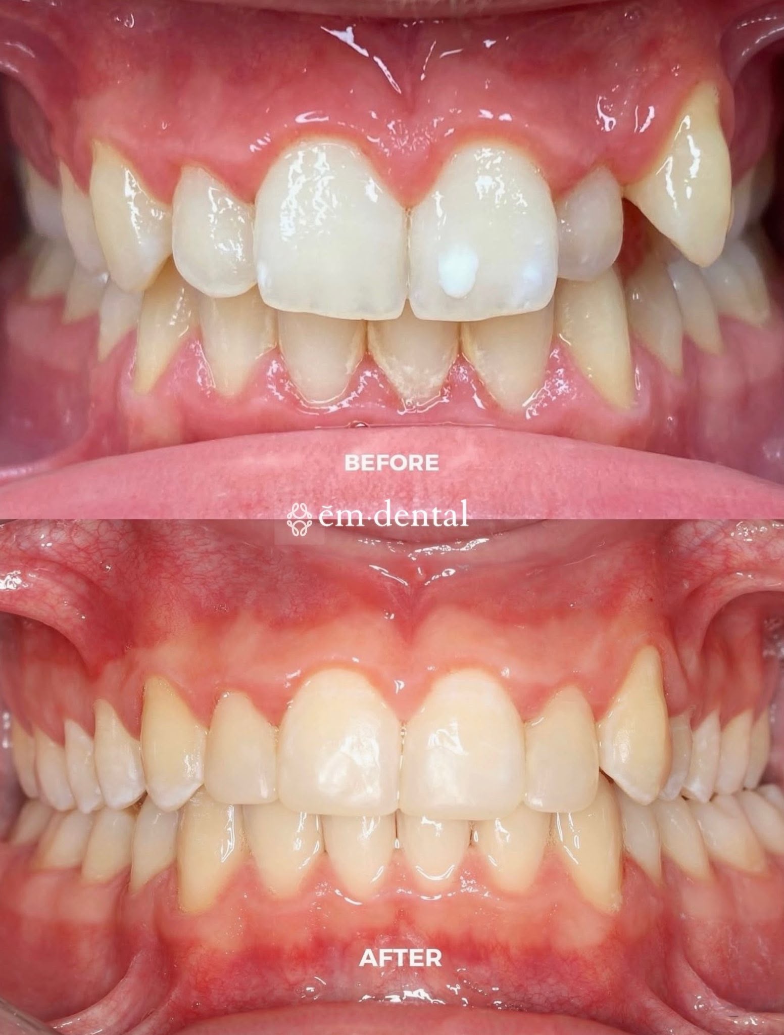 Invisalign London at ēm dental