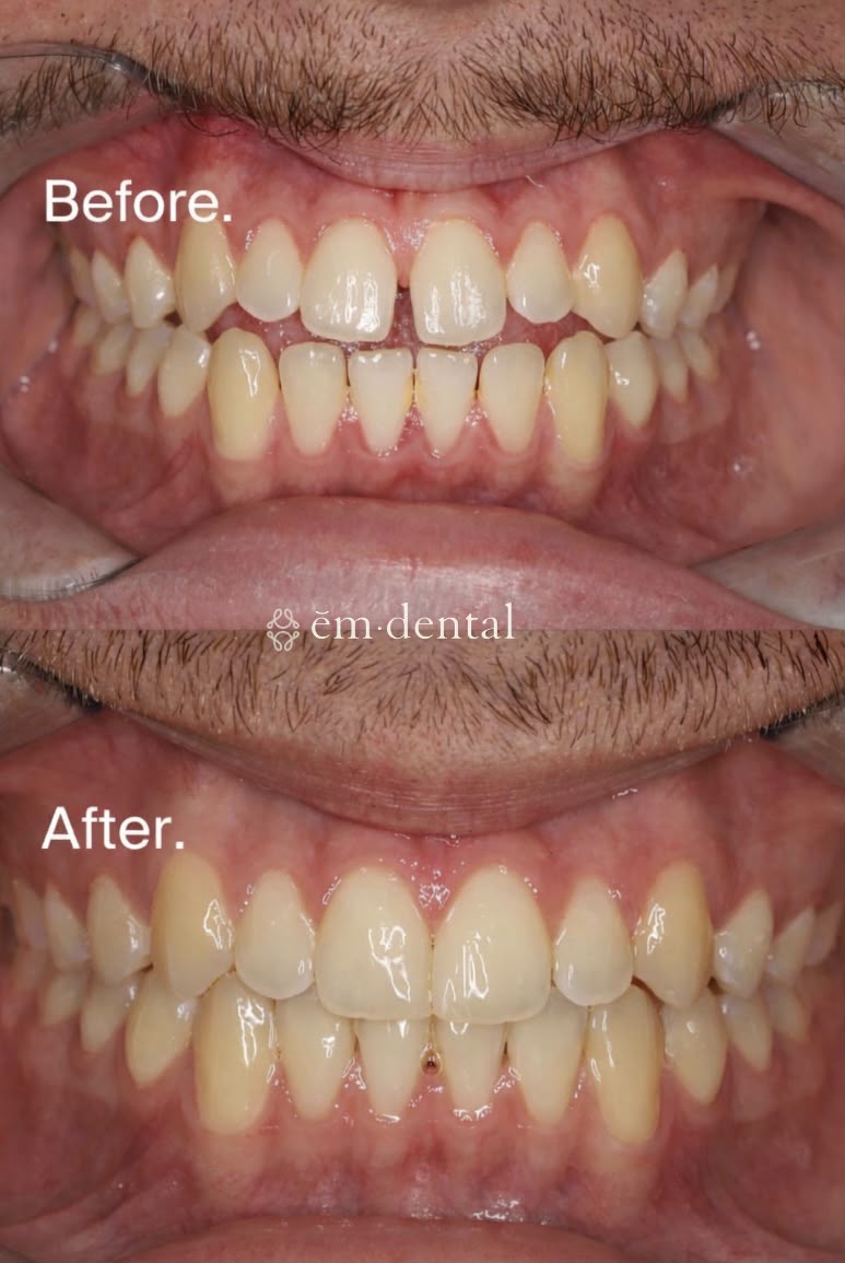 Invisalign clear aligners in London