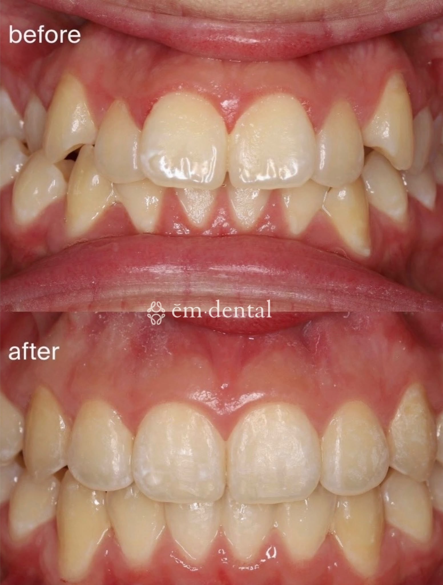Invisalign treatment in London at ēm dental