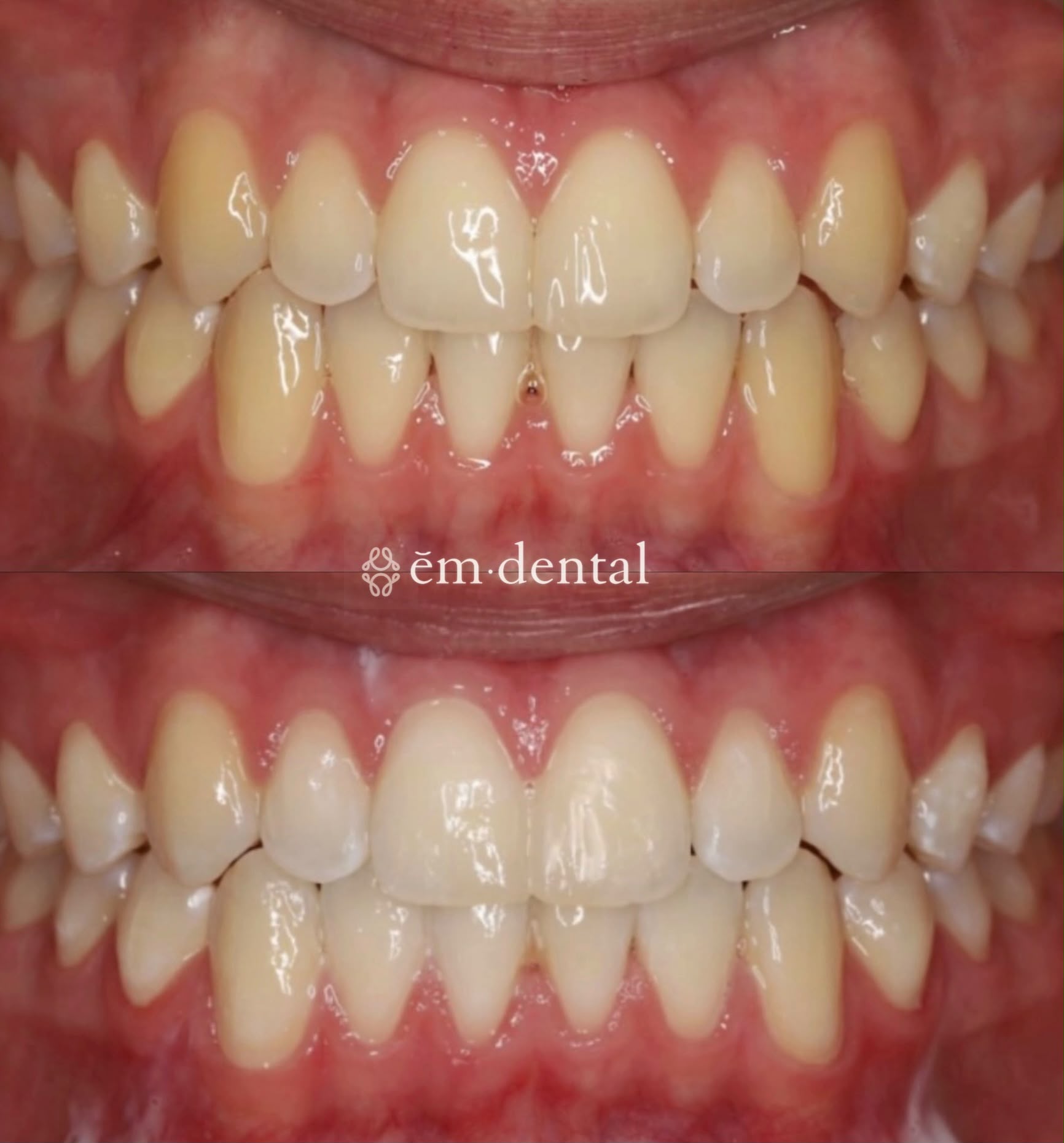 Teeth whitening London at ēm dental