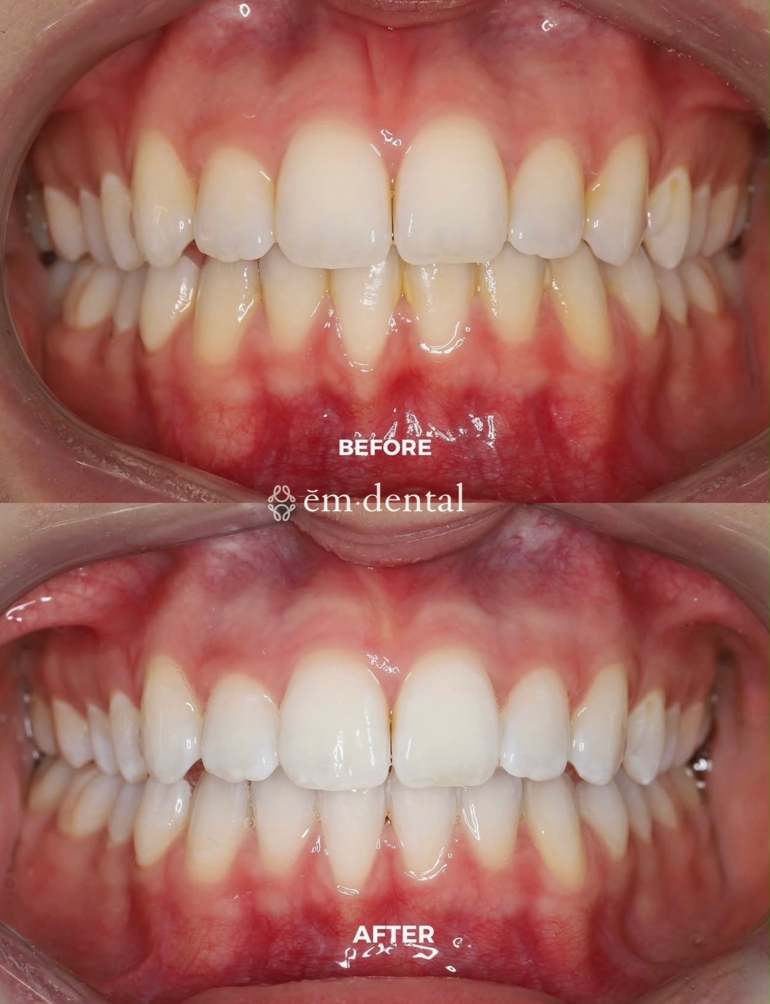 Professional teeth whitening in London